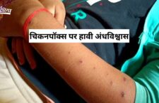 Lalitpur news, Superstition about chickenpox, no awareness