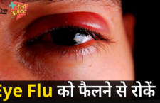 eye flu remedy