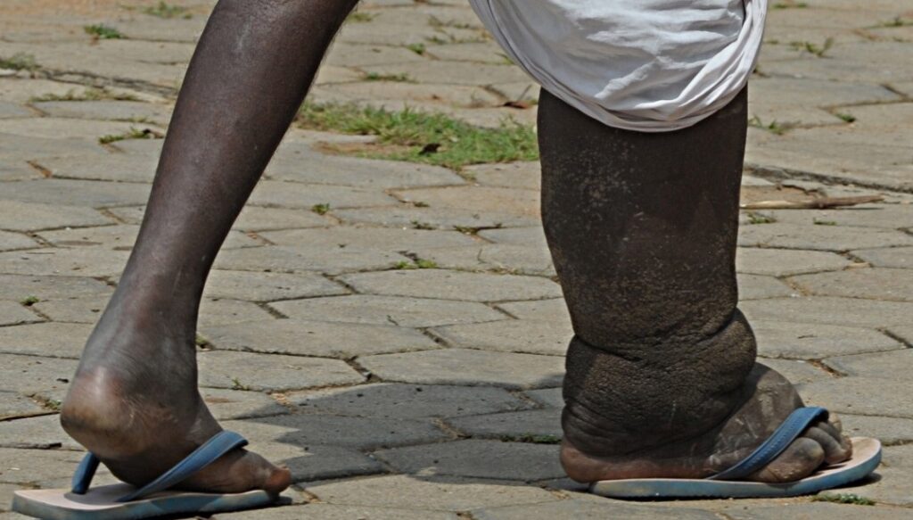 Elephantiasis, 40% people in India are suffering from 'elephant feet' disease, know the treatment, symptoms 