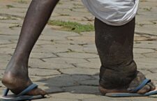 Elephantiasis, 40% people in India are suffering from 'elephant feet' disease, know the treatment, symptoms