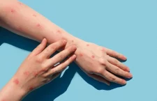 WHO declared monkeypox a global threat, know what is this disease and symptoms