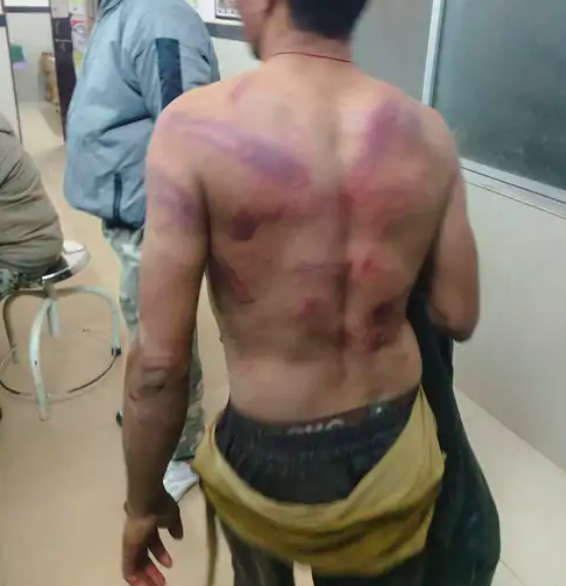Deep marks on the body after the beating